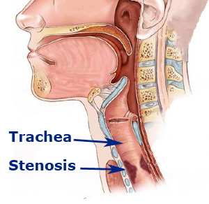 tracheal